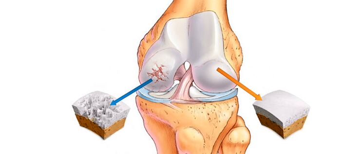 Arthrose déformante de l'articulation du genou (à gauche) et d'une articulation saine (à droite)